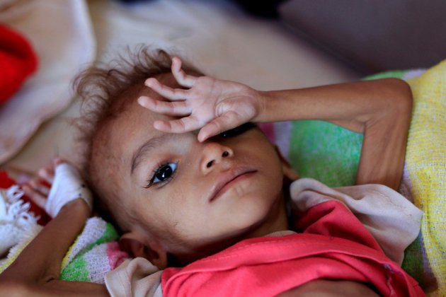 Au Yémen en guerre, la famine frappe et tue des enfants