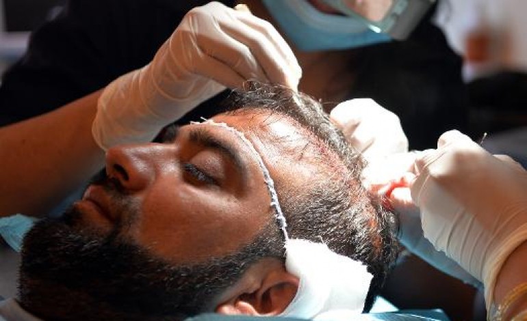 Peshawar (Pakistan) (AFP). Pakistan: la greffe de cheveux, nouvelle arme de séduction massive 