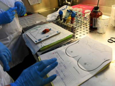 Des spécialistes de l'Institut Paoli-Calmettes (IPC) à Marseille s'apprêtent à examiner une tumeur, le 9 octobre 2017 - ANNE-CHRISTINE POUJOULAT [AFP]