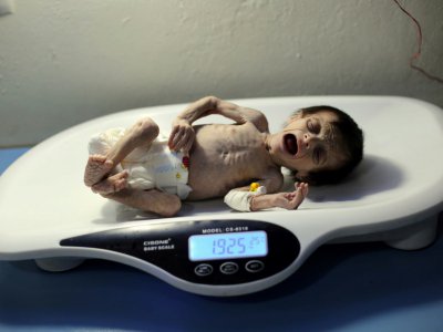 Une petite fille syrienne souffrant de malnutrition aiguë est pesée dans un hôpital de Hamouria, dans la Ghouta oriental - Amer ALMOHIBANY [AFP]