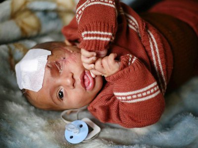 Un bébé qui a perdu un oeil et sa mère dans un bombardement de l'armée syrienne, le 24 décembre 2017 à Bayt Siwa, dans la Ghouta orientale - Amer ALMOHIBANY [AFP/Archives]