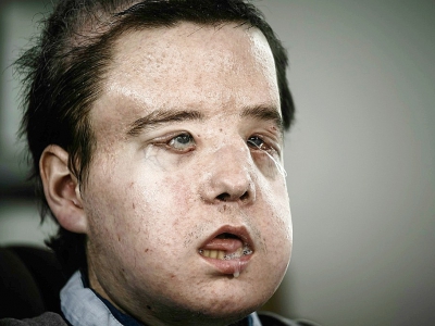 Jérôme Hamon, premier homme au monde à avoir subi deux greffes de la face, le 13 avril 2018 à l'hôpital européen Georges-Pompidou, à Paris - Philippe LOPEZ [AFP]