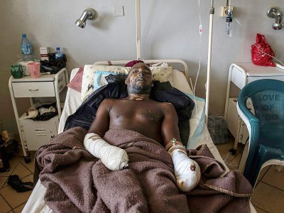 Un blessé est soigné de brulures à l'hôpital de Jos, le 28 juin 2018, après un massacre dans le centre du Nigeria. - STEFAN HEUNIS [AFP]