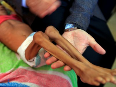 Un enfant yéménite souffrant de malnutrition reçoit des soins dans un hôpital de Sanaa le 6 octobre 2018 - Mohammed HUWAIS [AFP]