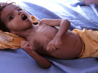 Un enfant souffrant de malnutrition allongé dans un lit d'hôpital, dans la province de Hajjah, dans le nord-ouest du Yémen, le 25 octobre 2018 - ESSA AHMED [AFP/Archives]