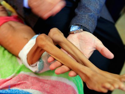 Un enfant yéménite souffrant de malnutrition reçoit des soins dans un hôpital de Sanaa le 6 octobre 2018 - Mohammed HUWAIS [AFP]