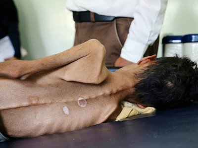 Ghazi Ali ben Ali, un Yéménite de 10 ans qui souffre de malnutrition aigüe, est allongé sur un lit le 30 octobre 2018 dans un hôpital de Jabal Habashi près de la ville de Taëz, dans le sud du Yémen - Ahmad AL-BASHA [AFP/Archives]