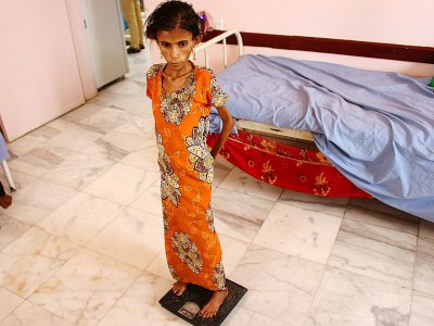 Fatima Hadi, une Yéménite déplacée de 12 ans souffrant de malnutrition aiguë, est pesée dans un hôpital de la province de Hajjah (nord-ouest) la 25 février 2019 - ESSA AHMED [AFP/Archives]