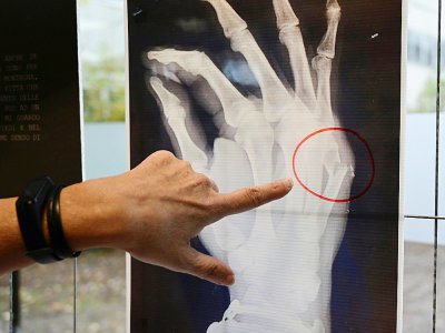 Un médecin montre les os fracturés sur une radiographie lors d'une exposition sur les violences faites aux femmes à l'hôpital San Carlo de Milan, le 22 novembre 2019 - MIGUEL MEDINA [AFP]
