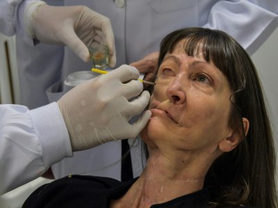 Le docteur Rodrigo Salazar-Gamarra place une prothèse sur le visage de Denise Vicentin, le 3 décembre 2019 à l'hôpital de Sao Paulo - Nelson ALMEIDA [AFP]