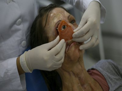 Un docteur fait un essai avec une prothèse oculaire sur Denise Vicentin, à l'hôpital de Sao Paulo, le 1er novembre 2019 - Miguel SCHINCARIOL [AFP]