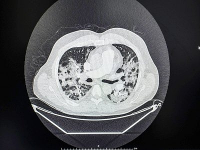 Un scanner de poumons d'un patient infecté par le Covid-19 - LUCAS BARIOULET [AFP/Archives]
